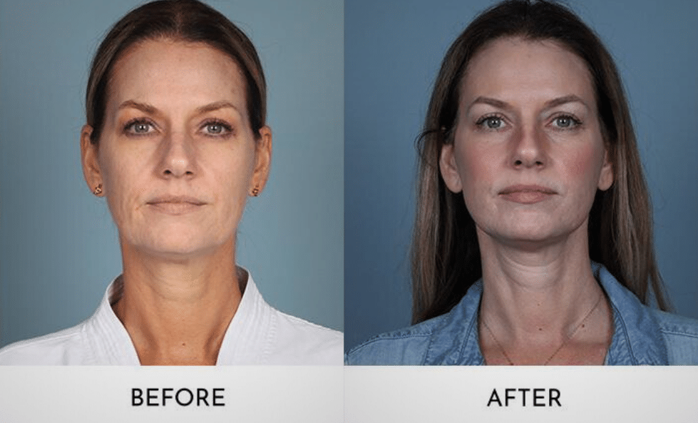 Brow Lift: Transformative Aesthetics at Aesthetic MDR