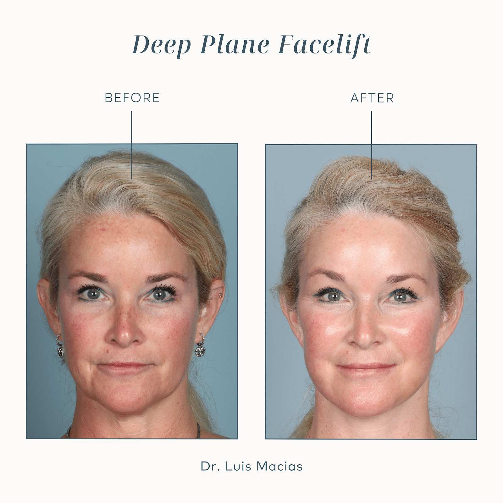 The Ideal Age for a Facelift (2)